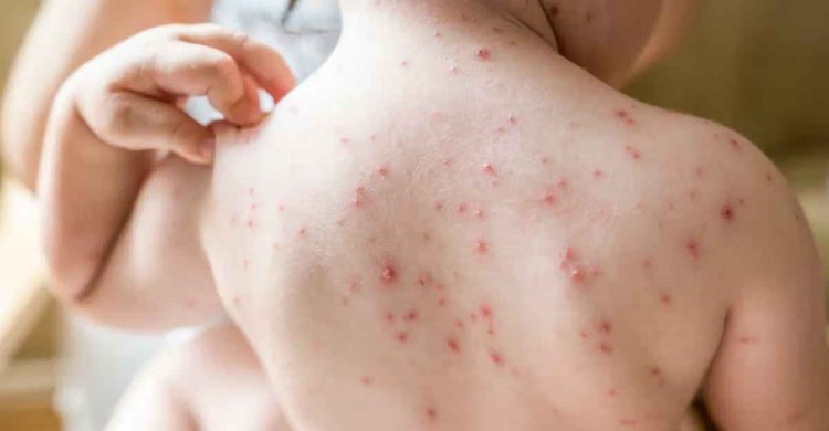 হাম: কেন হয়, লক্ষণ ও করনীয়